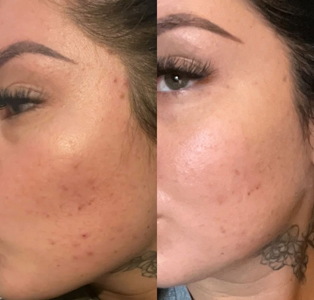 30% Blue Algae Microneedle Mask (Acne Prone)