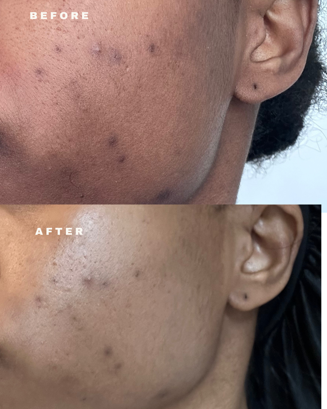 30% Blue Algae Microneedle Mask (Acne Prone)