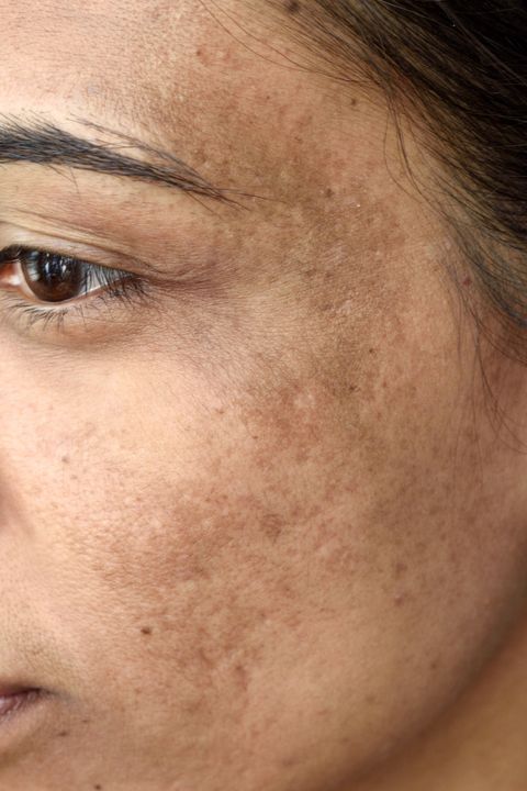 Coping with Melasma: Tips for Boosting Confidence and Self-Esteem