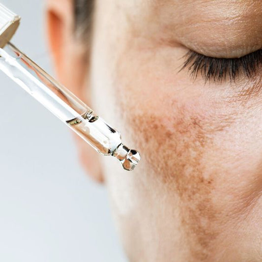 Understanding Melasma: Shedding Light on a Common Skin Concern