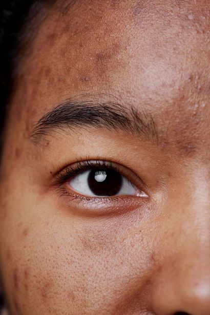 Hyperpigmentation Demystified: Dispelling Common Myths